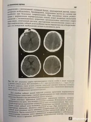 Хирургическое лечение тяжелой черепно-мозговой травмы – тема научной статьи  по клинической медицине читайте бесплатно текст научно-исследовательской  работы в электронной библиотеке КиберЛенинка