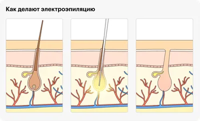 Что такое ЭлектроЭпиляция? | ЭлектроЭпиляция | Москва | Дзен