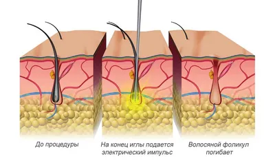 Электроэпиляция в Алматы