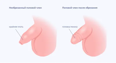 ФИМОЗ Фимоз - это сужение отверстия крайней плоти, препятствующее обнажению  головки пениса. Фимоз.. | ВКонтакте