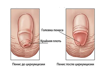 ᐉ Обрезание при фимозе у взрослых • Циркумцизия как метод лечения фимоза у  взрослых мужчин