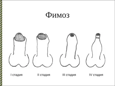 Фимоз – лечить или не лечить? | АМС-Медионика