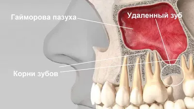 Гайморова пазуха и зубы: функция, проблемы и лечение