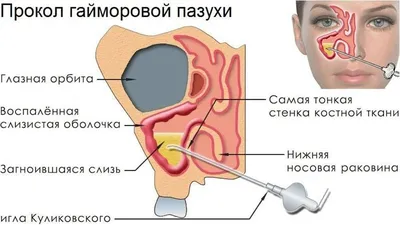 Рак носа: симптомы опухоли носа и гайморовой пазухи | Онкология носовой  полости