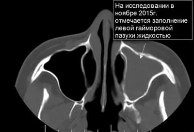 Мицетома гайморовой пазухи на МРТ