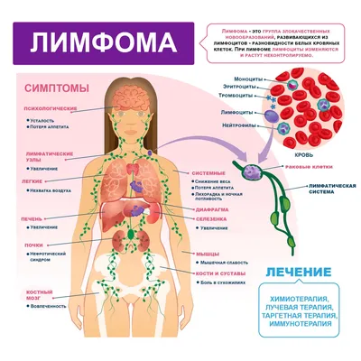 Распространнение рака по лимфатической системе: метастазы в лимфоузлах,  определение стадии рака