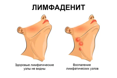 Воспаление лимфоузлов - Беттертон