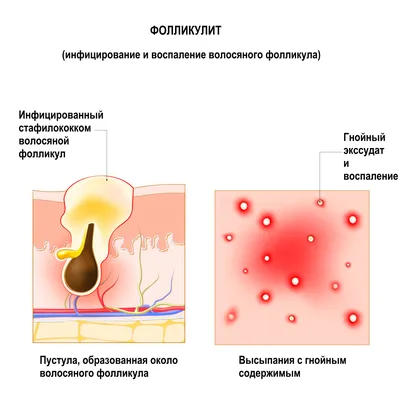 Рак полового члена: симптомы, признаки, диагностика, лечение