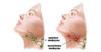 Уплотнения в области паха у детей | Клиника Фэнтези