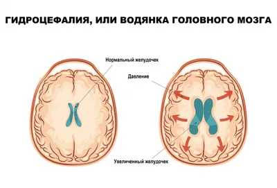 Водянка мозга или гидроцефалия у детей: что это такое и насколько страшна  «вода» в голове | О детском здоровье: с врачебного на родительский | Дзен