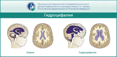 Гидроцефалия головного мозга на МРТ у взрослого - заключение МРТ в клинике  «Союз»