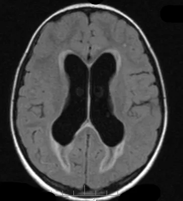 Лечение гидроцефалии головного мозга у взрослых - лечение умеренной,  наружной и смешанной гидроцефалии