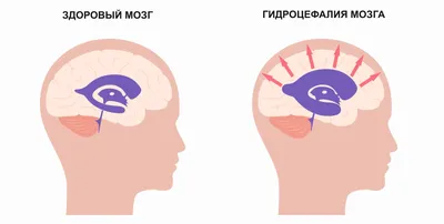 Гидроцефалия головного мозга (водянка) - что это такое, лечение, симптомы,  причины