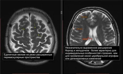 Что такое гидроцефалия, из-за чего рождаются дети с увеличенным черепом и  как лечат гидроцефалию нейрохирурги НИКИ педиатрии?.. | ВКонтакте