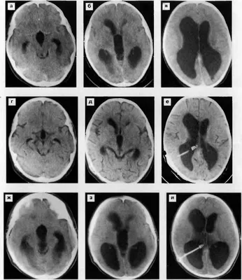 Статьи по теме «гидроцефалия» — Naked Science