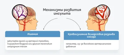 БРОШЮРА ДЛЯ ПАЦИЕНТА С ИНСУЛЬТОМ