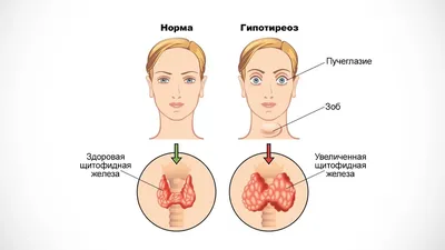 Пост на тему: «Как проявляется гипотиреоз у взрослого человека». - Центр  медицинской профилактики и реабилитации Калининградской области