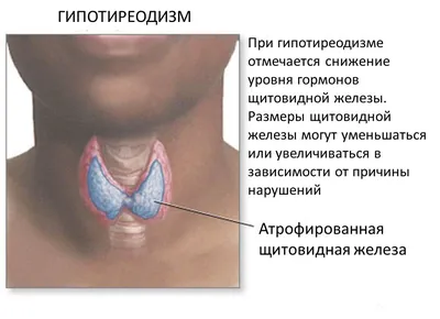 Гипотиреоз: Причины. Главные причины гипотиреоза. Лекция к.м.н., доктора  А.В. Ушакова - YouTube