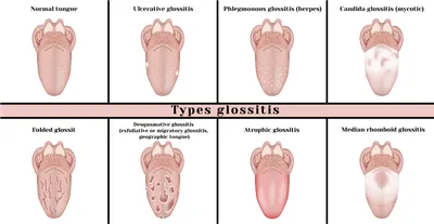 Лечение глоссита – препараты и народные средства