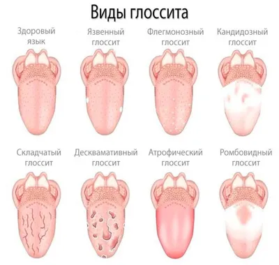 Воспаление языка с атрофией сосочков – глоссит Гюнтера – Миллера · Вечерний  Мурманск