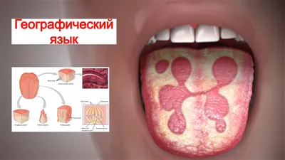 Кандидозный стоматит - симптомы острой и хронической форм, стадии и  признаки у мужчин и женщин, причины появления, диагностика и лечение  заболевания