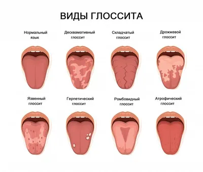 Опух Язык Распух Что Делать Как Убрать ЛюмиДент