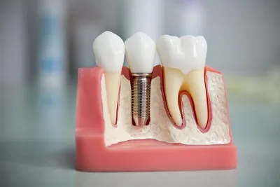 Имплантация зубов картинки обои