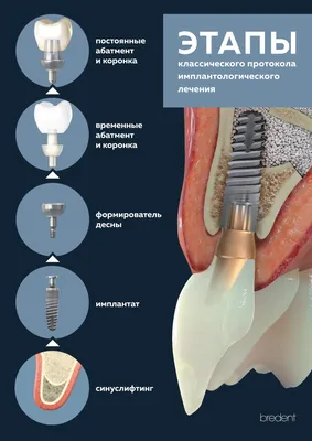 Имплантация зубов - Стоматологическая клиника Дзен