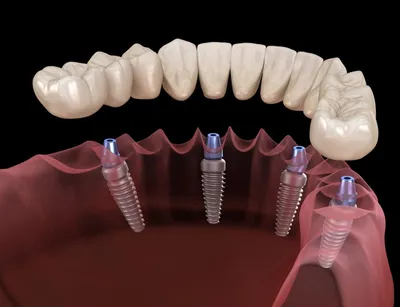 Имплантация при полном отсутствии зубов | Цены