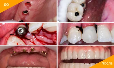 Имплантация зубов — этапы, виды, фото, как делают операцию по установке  зубного импланта?