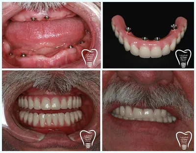 Имплантация зубов - стоит ли делать? - Cтоматология Май