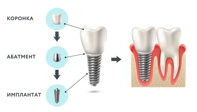 Имплантация зубов в Киеве — зубные импланты цена