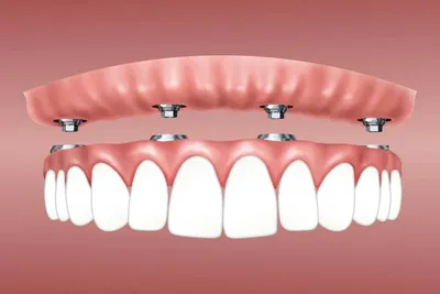 Полезный гид по имплантации зубов