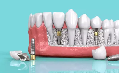 Замена всех зубов на импланты в клинике \"Славная Улыбка\"