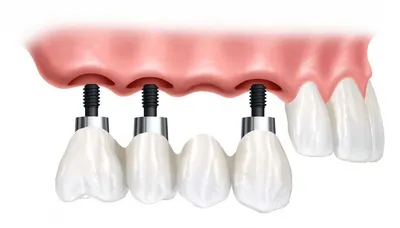 Что такое одноэтапная имплантация зубов?