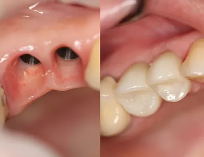 Имплантация зубов при дисфункции ВНЧС | НК Клиник