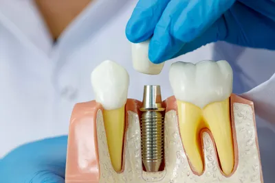 Имплантация зубов в СПБ - Цена на зубные импланты с установкой