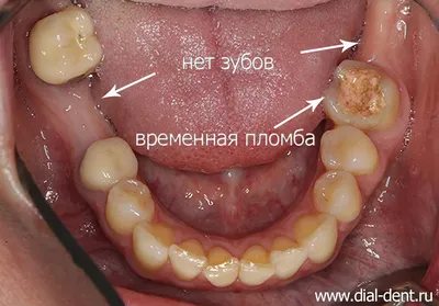 Имплантация зубов в Новосибирске - Videdent.ru