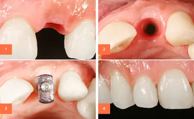 Имплантация зубов в Перми - цена от 28000 на имплант зуба установка под  ключ в стоматологии «ЭСТ»