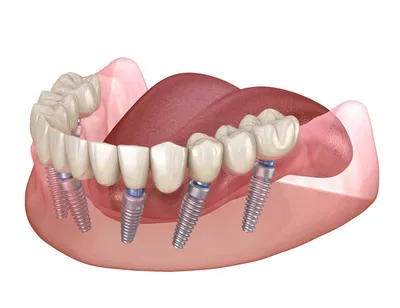 Имплантация зубов больно ли делать - Cтоматология Май