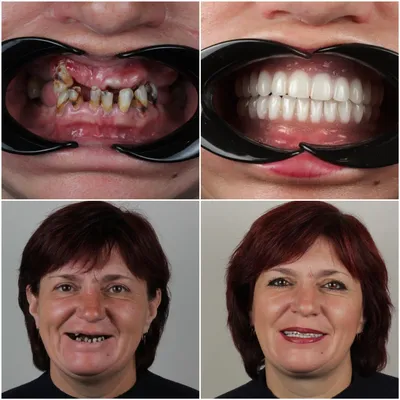 Бескровная имплантация зубов, импланты без разрезов, безоперационная  имплантация