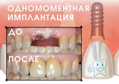 Экспертная имплантация зубов в Рассвете | Клиника Рассвет