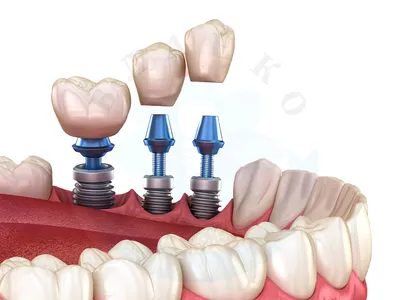 Имплантация зубов – VivaDens