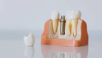 Имплантация зубов в Перми - импланты зубов от 25 тыс. рублей