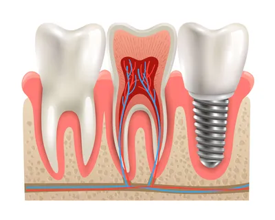Имплантация зубов в Краснодаре: установка, типы, преимущества, отзывы, цены  - Стоматология доктора Айрумова «32 Clinic»