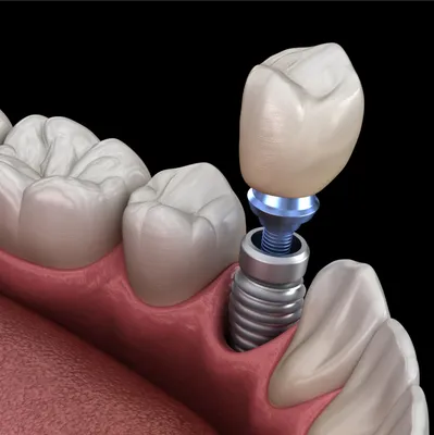Имплантация зубов - технология осуществления | Стоматология «Интерстом»