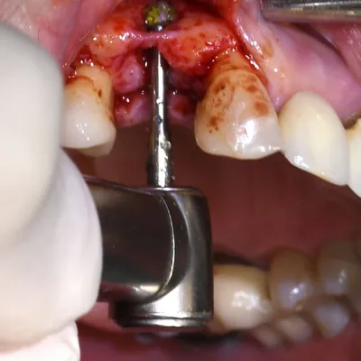 Имплантация зубов: этапы и сроки | Блог | Стоматология «Дент Тайм»