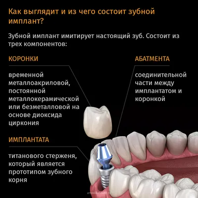 Имплантация с протезированием за 24 часа в Перми - ООО «Центр Стоматологии  32 Практика»