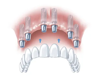 Имплантация зубов с немедленной нагрузкой: факторы риска | bioimplantat.ru