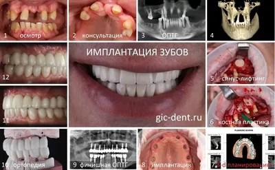 Протезирование зубов - Стоматологическая Клиника МК ДЕНТ